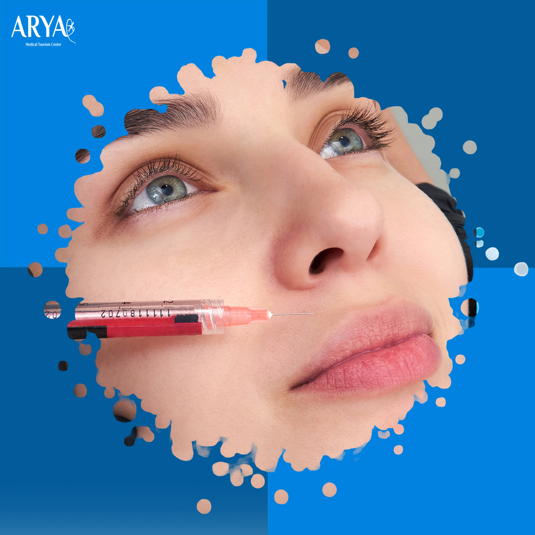 Injections de Filler